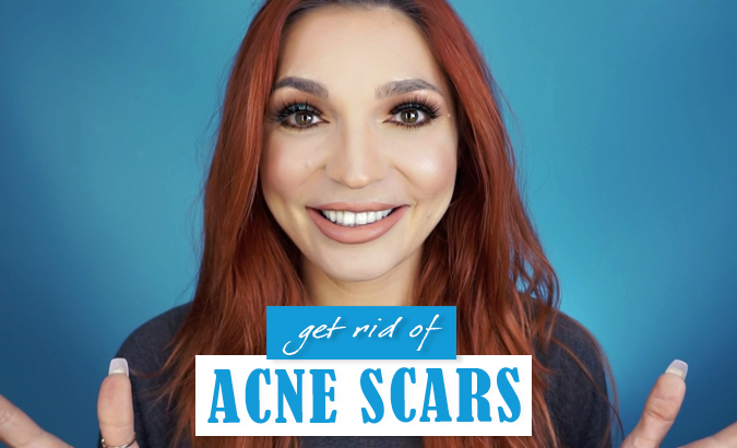 How To Get Rid of Acne Scars (Email Subscribers Only)