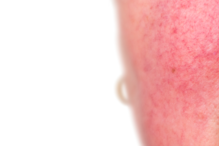 At-home help with Rosacea